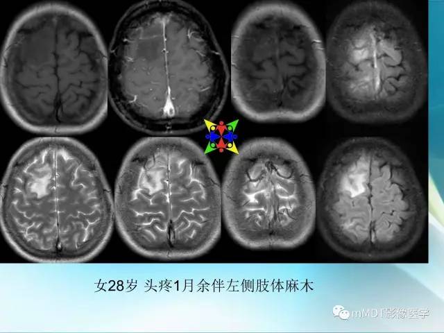 【PPT】脑静脉及静脉窦血栓影像诊断