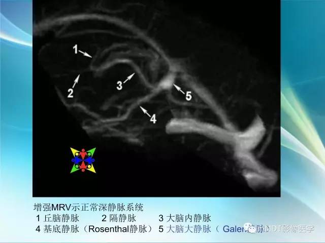 【PPT】脑静脉及静脉窦血栓影像诊断