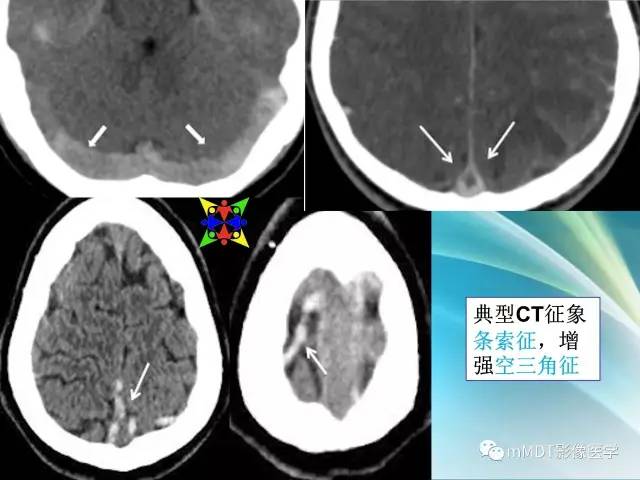 【PPT】脑静脉及静脉窦血栓影像诊断