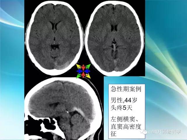 【PPT】脑静脉及静脉窦血栓影像诊断