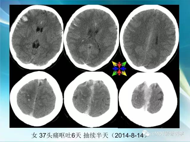 【PPT】脑静脉及静脉窦血栓影像诊断
