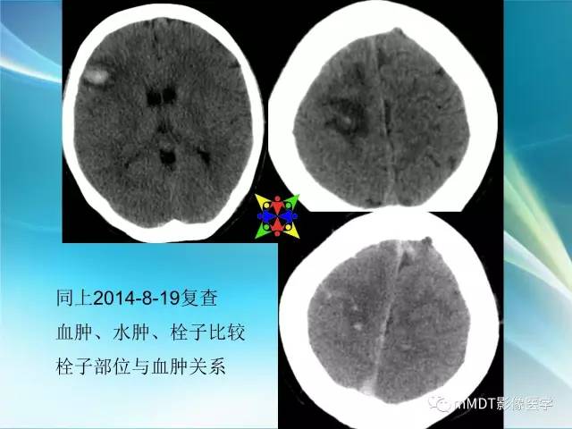 【PPT】脑静脉及静脉窦血栓影像诊断