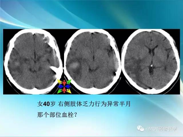 【PPT】脑静脉及静脉窦血栓影像诊断