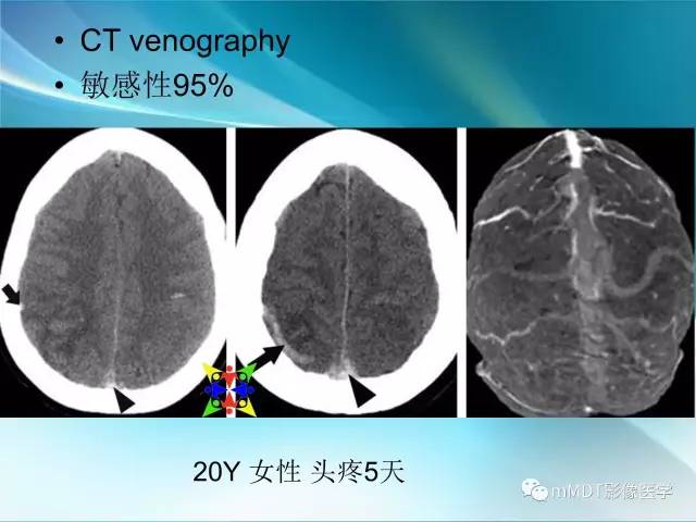 【PPT】脑静脉及静脉窦血栓影像诊断