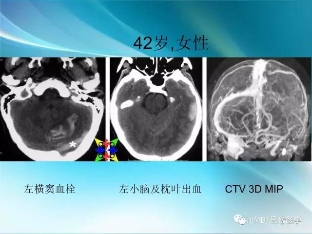 【PPT】脑静脉及静脉窦血栓影像诊断