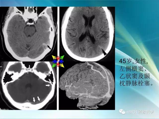【PPT】脑静脉及静脉窦血栓影像诊断