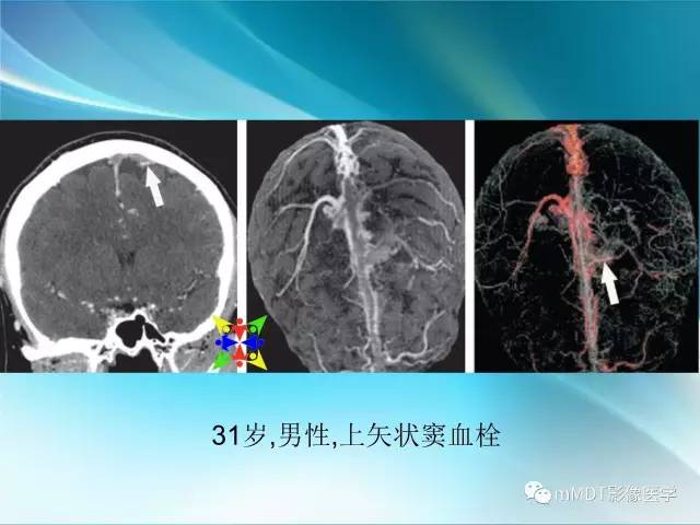 【PPT】脑静脉及静脉窦血栓影像诊断
