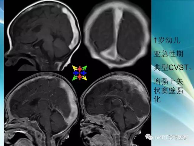 【PPT】脑静脉及静脉窦血栓影像诊断