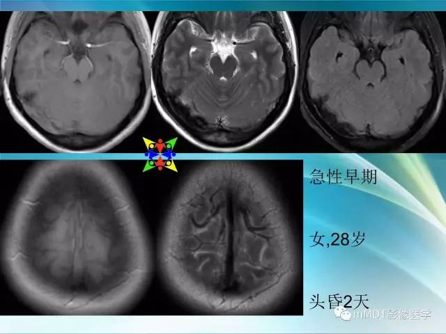 【PPT】脑静脉及静脉窦血栓影像诊断
