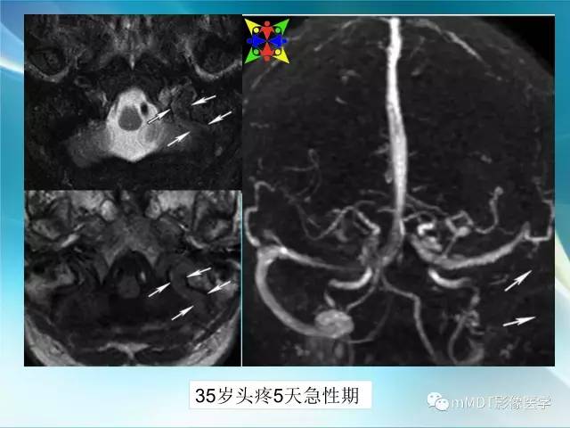 【PPT】脑静脉及静脉窦血栓影像诊断
