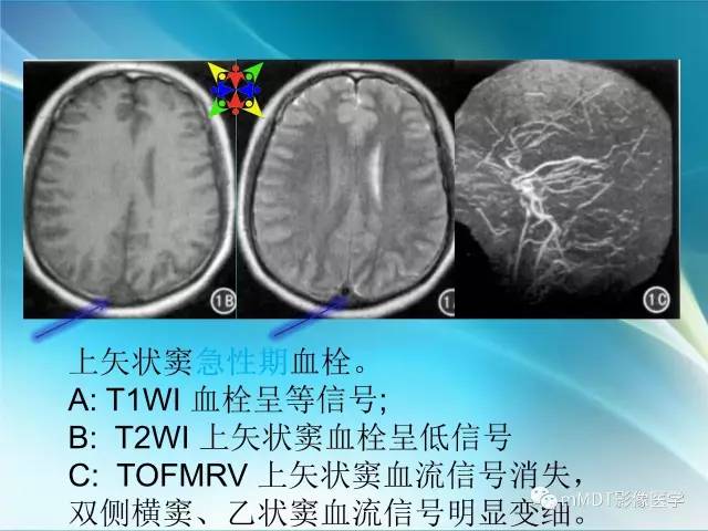 【PPT】脑静脉及静脉窦血栓影像诊断