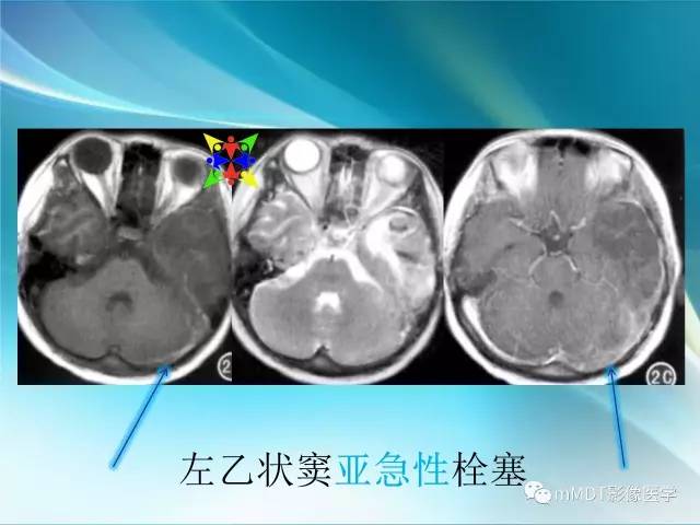 【PPT】脑静脉及静脉窦血栓影像诊断