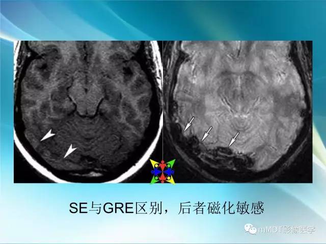【PPT】脑静脉及静脉窦血栓影像诊断
