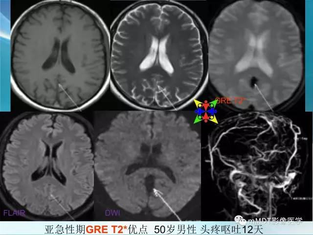 【PPT】脑静脉及静脉窦血栓影像诊断