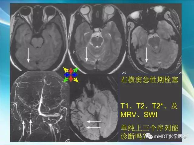 【PPT】脑静脉及静脉窦血栓影像诊断