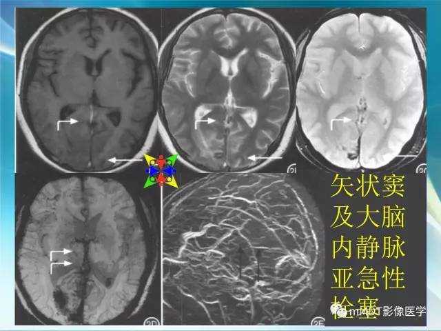 【PPT】脑静脉及静脉窦血栓影像诊断