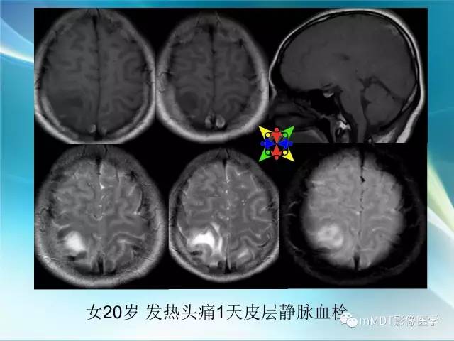 【PPT】脑静脉及静脉窦血栓影像诊断