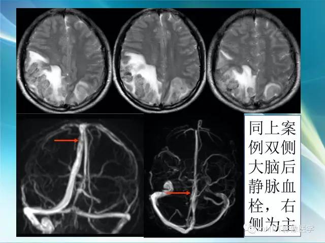 【PPT】脑静脉及静脉窦血栓影像诊断