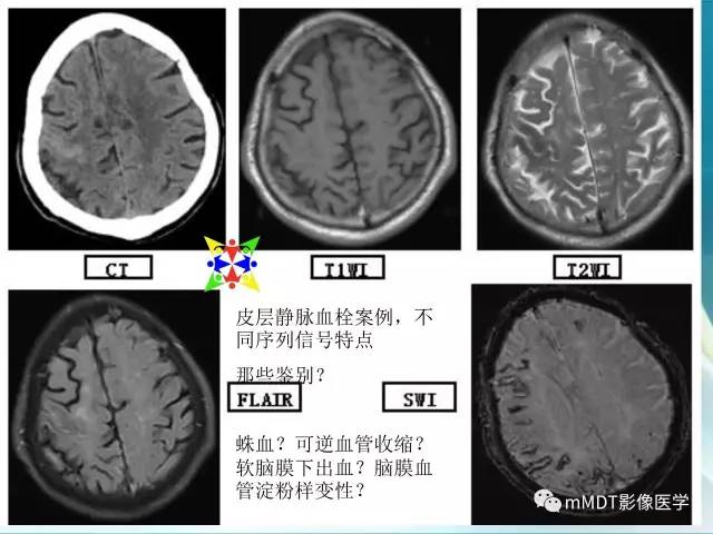 【PPT】脑静脉及静脉窦血栓影像诊断