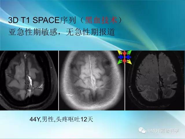 【PPT】脑静脉及静脉窦血栓影像诊断