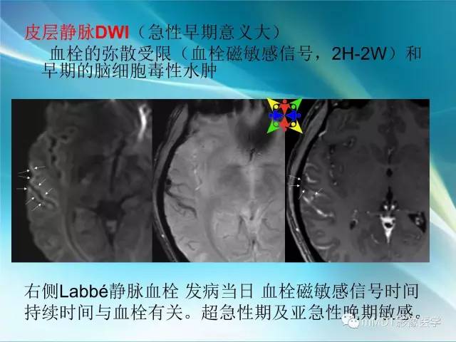 【PPT】脑静脉及静脉窦血栓影像诊断