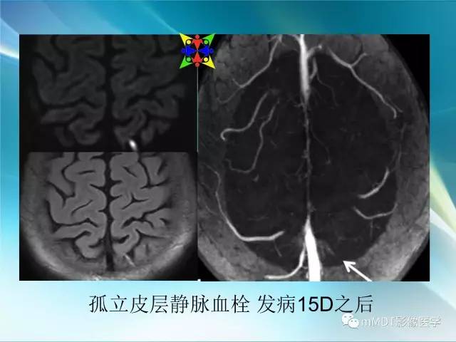 【PPT】脑静脉及静脉窦血栓影像诊断
