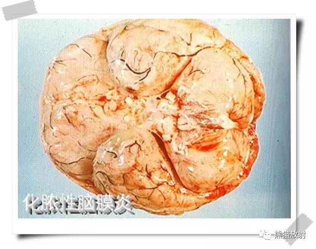 颅内感染性疾病——急性化脓性脑膜炎、化脓性脑脓肿影像病理 颅内感染性疾病——急性化脓性脑膜炎、化脓性脑脓肿影像病理