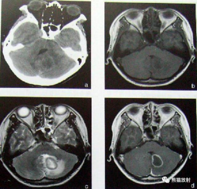 颅内感染性疾病——急性化脓性脑膜炎、化脓性脑脓肿影像病理 颅内感染性疾病——急性化脓性脑膜炎、化脓性脑脓肿影像病理