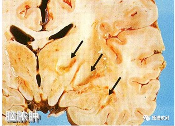 颅内感染性疾病——急性化脓性脑膜炎、化脓性脑脓肿影像病理 颅内感染性疾病——急性化脓性脑膜炎、化脓性脑脓肿影像病理