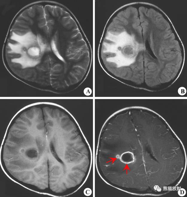 颅内感染性疾病——急性化脓性脑膜炎、化脓性脑脓肿影像病理 颅内感染性疾病——急性化脓性脑膜炎、化脓性脑脓肿影像病理