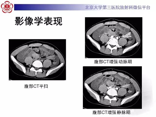 【病例】肠系膜纤维瘤病1例CT影像表现