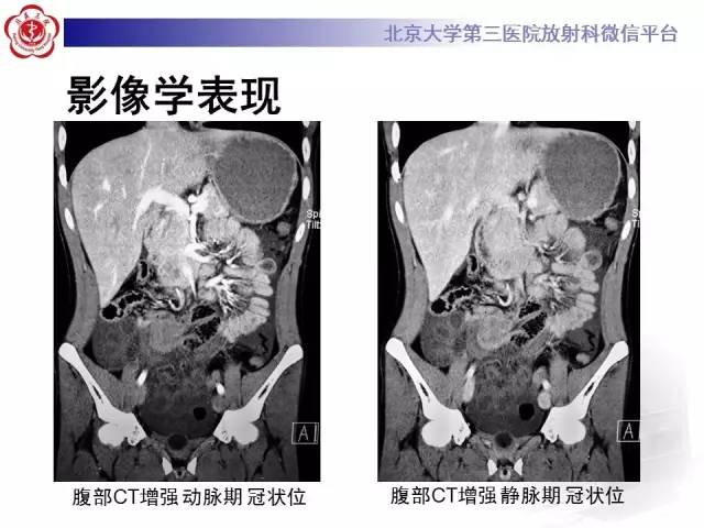 【病例】肠系膜纤维瘤病1例CT影像表现