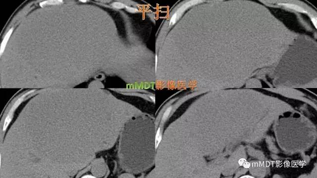 【PPT】肝上皮样血管平滑肌脂肪瘤诊断与鉴别