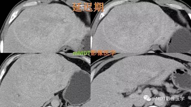 【PPT】肝上皮样血管平滑肌脂肪瘤诊断与鉴别