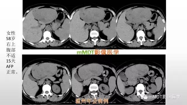 【PPT】肝上皮样血管平滑肌脂肪瘤诊断与鉴别