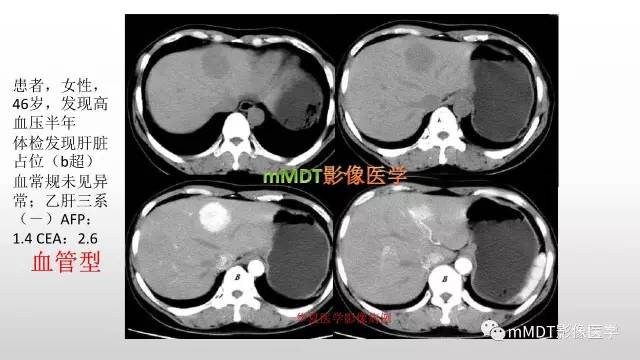【PPT】肝上皮样血管平滑肌脂肪瘤诊断与鉴别