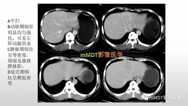 【PPT】肝上皮样血管平滑肌脂肪瘤诊断与鉴别