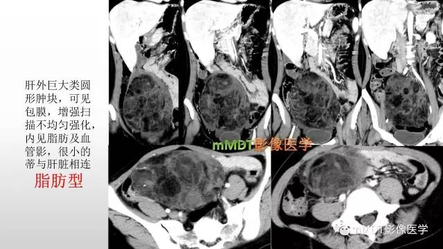 【PPT】肝上皮样血管平滑肌脂肪瘤诊断与鉴别
