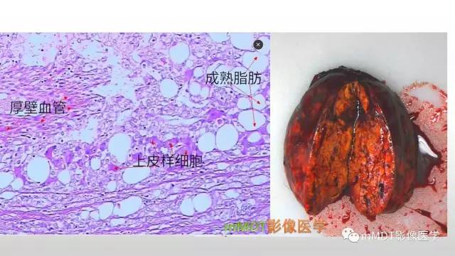 【PPT】肝上皮样血管平滑肌脂肪瘤诊断与鉴别
