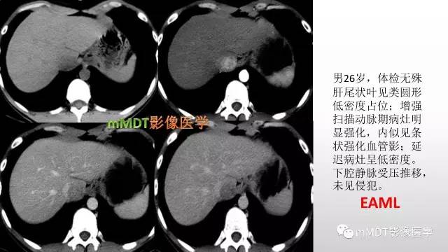 【PPT】肝上皮样血管平滑肌脂肪瘤诊断与鉴别