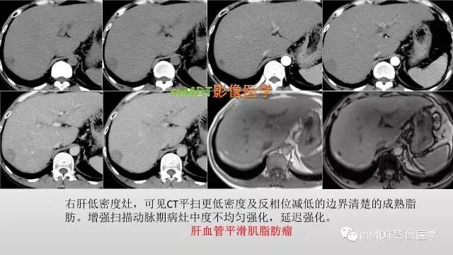 【PPT】肝上皮样血管平滑肌脂肪瘤诊断与鉴别
