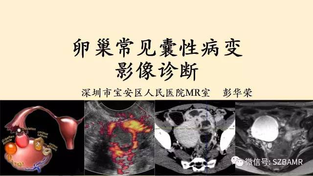 【PPT】卵巢常见囊性病变影像诊断