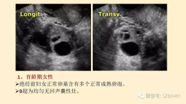 【PPT】卵巢常见囊性病变影像诊断