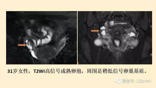 【PPT】卵巢常见囊性病变影像诊断
