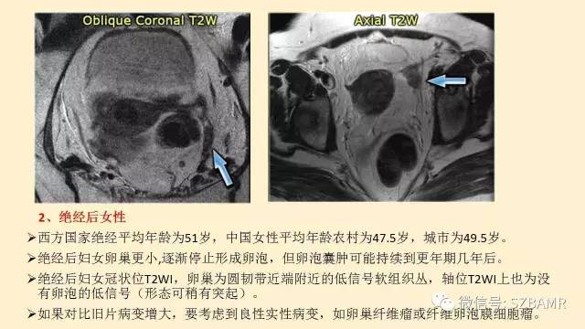 【PPT】卵巢常见囊性病变影像诊断