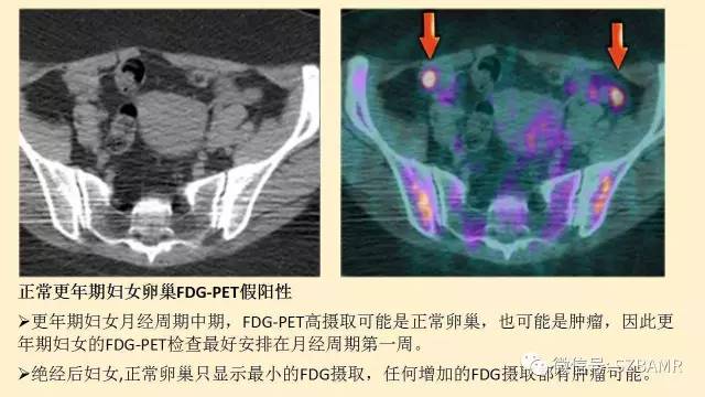 【PPT】卵巢常见囊性病变影像诊断