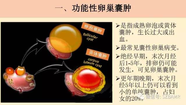 【PPT】卵巢常见囊性病变影像诊断