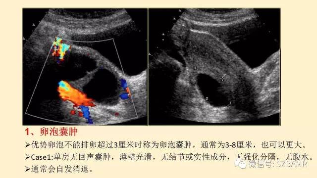 【PPT】卵巢常见囊性病变影像诊断