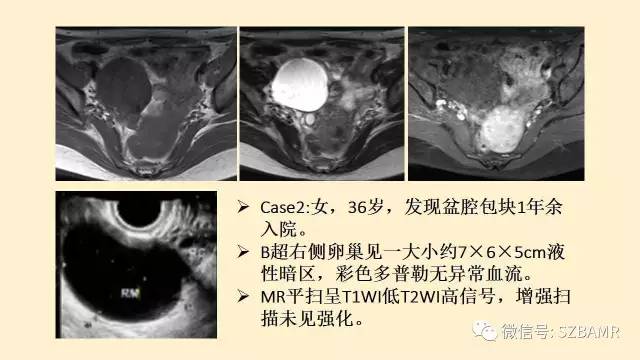 【PPT】卵巢常见囊性病变影像诊断