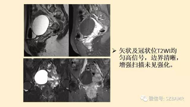 【PPT】卵巢常见囊性病变影像诊断